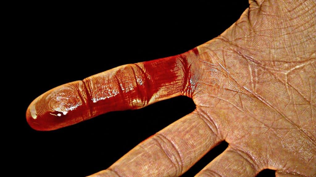 Damit Blessuren nicht zum Gesundheitsrisiko werden